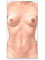 Breast surgical treatment