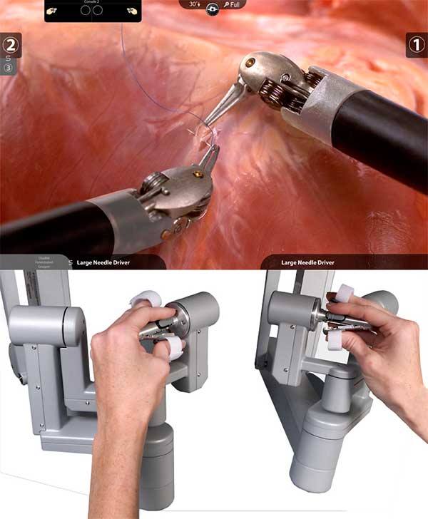 Ρομποτική χειρουργική της παχυσαρκίας (By Pass και Sleeve γαστρεκτομή)